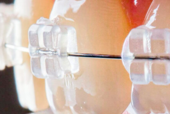 сапфірові брекети